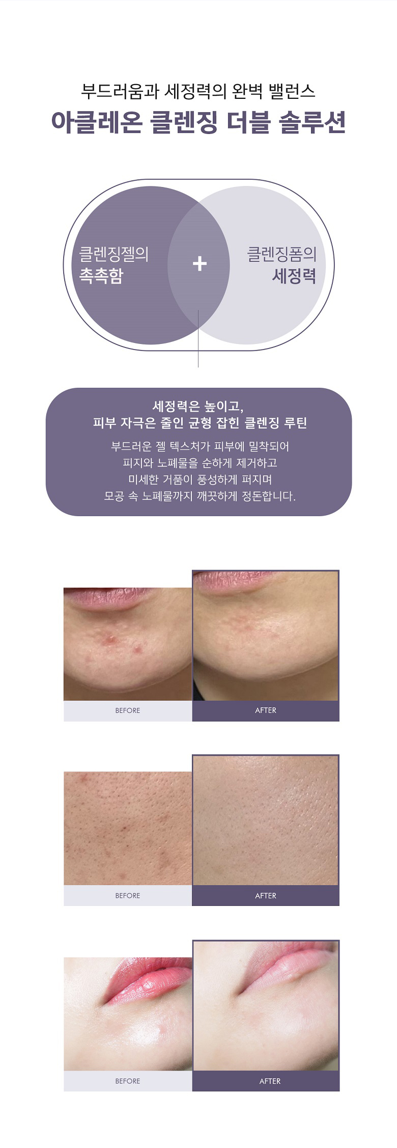 아클레온 좁쌀 여드름 폼클렌징 수부지 약알칼리성 클렌징폼 200ml 상세 이미지 3